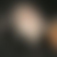 Aplasia cutis congenita. Übersichtsaufnahme: Seit Geburt bestehendes, 1,5 x 1,2 cm großes, haarlo...