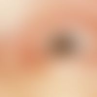 Arcus senilis corneae. Annular clouding of the cornea.
