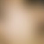 Argyrie: diffuse Graufärbung der Gesichtshaut nach mehrfachen Rollkuren wegen Ulcus ventriculi.

