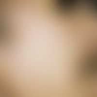Argyrie: diffuse Graufärbung der Gesichtshaut nach mehrfachen Rollkuren wegen Ulcus ventriculi.
