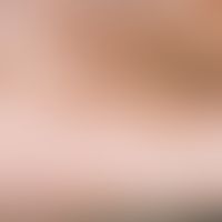 Arsenic keratoses; multiple, disseminated, symptomless, yellow-brownish, 0.1-0.3 cm large, cup-sh...