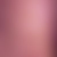 Completelyasymptomatic, yellowish-brownish, horny nodules of different size (0.1-0.4 cm) on both ...