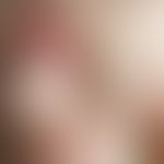 Artefakte. Akut aufgetretene, v.a. stammbetont verteilte, scharf begrenzte, z.T. bizarr berandete...