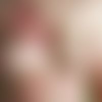 Artefakte. Akut aufgetretene, v.a. stammbetont verteilte, scharf begrenzte, z.T. bizarr berandete...