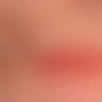 Artefakt. Akute BLasenbildung, nicht zu klärende Ursache.
