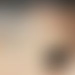 Arteriitis temporalis: strangartig verdickte, fokal indurierte und schmerzhafte Arteria temporali...