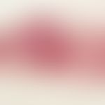 Arteriitis temporalis:&nbsp;kompletter Verschluss der Arteria temporalis. Deutliche entzündliche ...