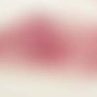 Arteriitis temporalis. complete occlusion of the arteria temporalis. distinct inflammatory infilt...