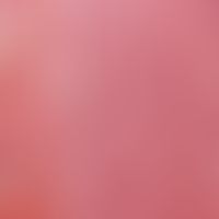Arteriitis temporalis. Detail enlargement: Thrombotic deposits. Vascular wall penetrated by infla...