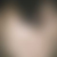 arteriitis temporalis. suddenly appeared, bizarrely configured, only moderately painful, large ul...