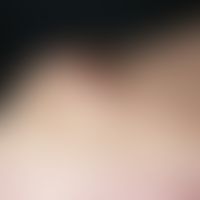 Atherom. Chronisch stationärer, seit mehr als 10 Jahren unmerklich wachsender, solitärer, scharf ...