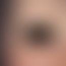 Atrichia congenita diffusa. Seit der Geburt fehlende Augenbrauen, Wimpern und Kopfhaare bei einem...