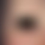 Atrichia congenita diffusa. Seit der Geburt fehlende Augenbrauen, Wimpern und Kopfhaare bei einem...