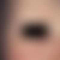 Atrichia congenita diffusa. Seit der Geburt fehlende Augenbrauen, Wimpern und Kopfhaare bei einem...
