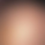 Atrichia congenita diffusa. Detailvergrößerung: Stirn- und Parietalbereich eines 18 Monate alten ...