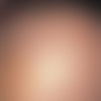 Atrichia congenita diffusa. detail enlargement: forehead and parietal region of an 18-month-old b...