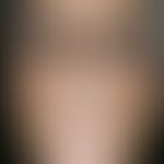 Atrophie der Haut:&nbsp;63 Jahre alte Patientin mit bekannter Porphyria cutanea tarda. Gleichmäßi...