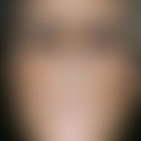 Atrophie der Haut:&nbsp;63 Jahre alte Patientin mit bekannter Porphyria cutanea tarda. Gleichmäßi...