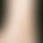 Atrophy blanche. roundish white scarred areas in a dirty brown hyperpigmentation in the area of t...