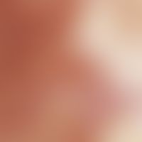 Atrophie blanche. Auflichtmikroskopie (Ausschnitt aus einer Läsion am Unterschenkel): Atrophisch-...