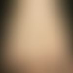 Atrophy, senile: parchment-like, pale yellow skin with clearly protruding veins in the area of th...