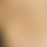 Atrophodermia idiopathica et progressiva: Confluent brownish foci with a central whitish sclerose...