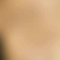 Atrophodermia idiopathica et progressiva: Confluent brownish foci with a central whitish sclerose...
