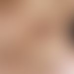 Atrophodermia idiopathica et progressiva: Large, erythematous-livid to brown, confluent, discreet...
