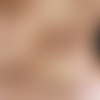 Atrophodermia idiopathica et progressiva: Large, erythematous-livid to brown, confluent, discreet...