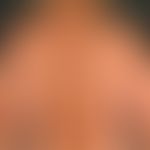 Atrophodermia idiopathica et progressiva: extensive, poorly indurated circumscribed circumscribed...