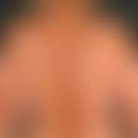 Atrophodermia idiopathica et progressiva: extensive, poorly indurated circumscribed circumscribed...