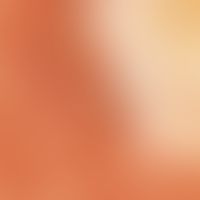 Auflichtmikroskopie. Vulvakarzinom. Nacktpapillärer Aspekt mit polymorphen Gefäßfiguren.