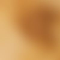 Auflichtmikroskopie. Verruca seborrhoica. Retikuläres Muster mit kompakten Netzstegen.