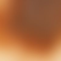 Auflichtmikroskopie. Dysplastischer melanozytärer Naevus. Retikuläres Pigmentmuster im Randbereich.