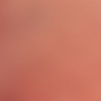Auflichtmikroskopie. Purpura. Punktförmige Kapillarerweiterungen mit intrakapillärer Thrombenbild...