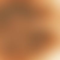 Auflichtmikroskopie. Melanozytärer Naevus vom Compound-Typ. Zentropapilläre grau-braune Globuli.
