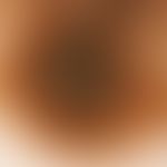 reflected light microscopy. melanoma, superficially spreading (SSM). marginal area, Clark level I...