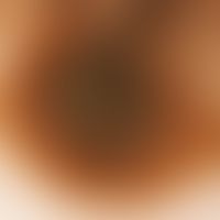 Auflichtmikroskopie. Melanom, superfiziell spreitendes (SSM). Randbereich, Clark Level III, TD 0,...