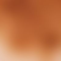 Auflichtmikroskopie. Melanozytärer Naevus vom Junktionsnaevus. Runde und polygonale Melanozytenne...