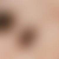 Auflichtmikroskopie. Kutane Melanommetastase. Grauschwarze Sacculi, geringes periläsionales Erythem.