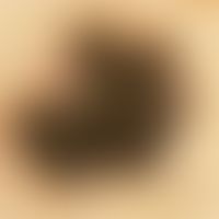 Auflichtmikroskopie. Initiales superfiziell spreitendes malignes Melanom, Clark Level II, TD 0,39...