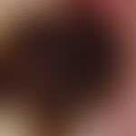Verruca seborrhoica: Sharply defined inhomogeneous pigmentation; numerous punctiform brightenings...
