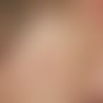 Auricular appendix: esit birth there is a sharply defined, symptomless, hard, smooth, skin-colore...