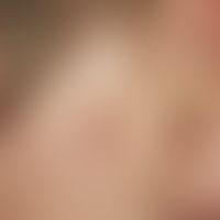 Auricular appendix: esit birth there is a sharply defined, symptomless, hard, smooth, skin-colore...