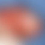 Balanitis erosiva circinata. sharply defined, bright red, shiny, flat, arched erosion of the glan...