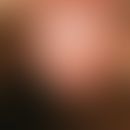 Balanitis parakeratotica circinata. chronic dynamic, 0.1 cm large, partly confluent pustules with...
