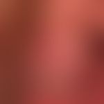 Balanitis simplex:&nbsp;seit mehreren Jahren bestehende, chronisch rezidivierende Balanitis ungek...