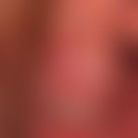 Balanitis simplex:&nbsp;seit mehreren Jahren bestehende, chronisch rezidivierende Balanitis ungek...