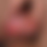 Balanoposthitis plasmacellularis. Übersichtsaufnahme: Seit 2 Jahren (!) in unterschiedlichem Ausm...