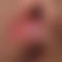 Balanoposthitis plasmacellularis:&nbsp;multizentrische, unscharf begrenzte Rötungen und Erosionen...